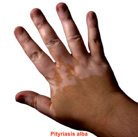 FAQ When the skin changes colour with atopic eczema is it caused